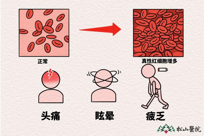 面色红润就是气色好?松山医院 警惕这种罕见血液病