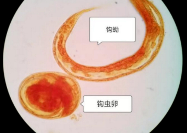 老人贫血20余年 元凶竟是"钩"在肠壁上的寄生虫|钩虫|贫血|感染_新浪