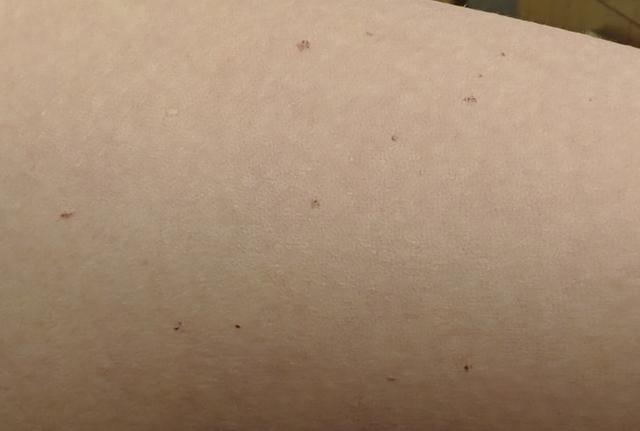 这篇文章告诉你|血管痣|小红点|血管_新浪新闻