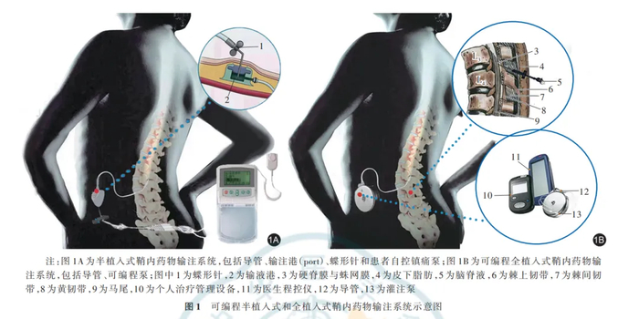 为什么打化疗有些有泵输液港只能静脉输液?错!它用途可大了!_新闻资讯_第8张_活检穿刺产品网 为什么打化疗有些有泵输液港只能静脉输液?错!它用途可大了!_https://www.jmylbn.com_新闻资讯_第8张