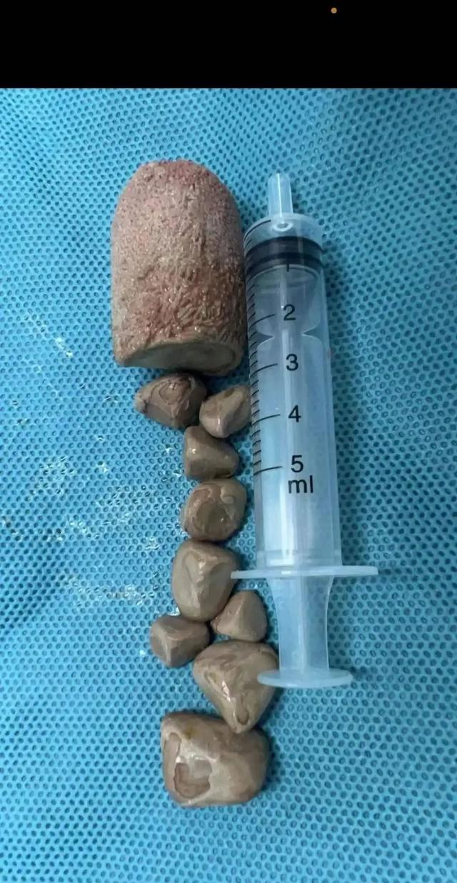 台州一男子体内长了个"手指头"|结石|泌尿|饮水量_新浪新闻