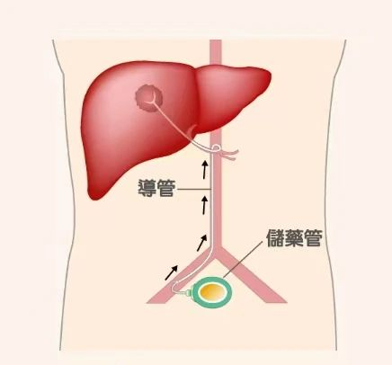 为什么打化疗有些有泵输液港只能静脉输液？错！它用途可大了！_https://www.jmylbn.com_新闻资讯_第5张