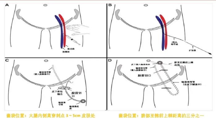 新生儿股静脉穿刺图解图片