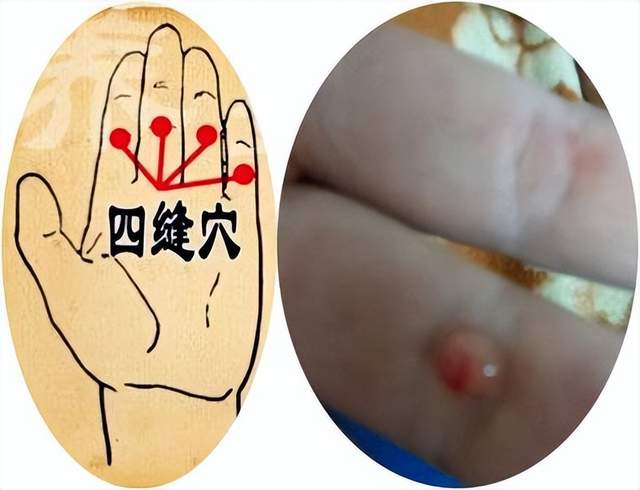 还可以在四缝穴点刺放血.