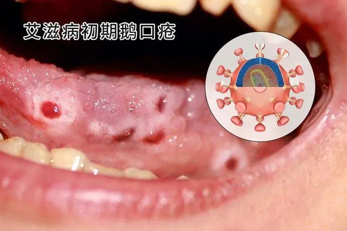 感染|淋病|尖锐湿疣_新浪新闻