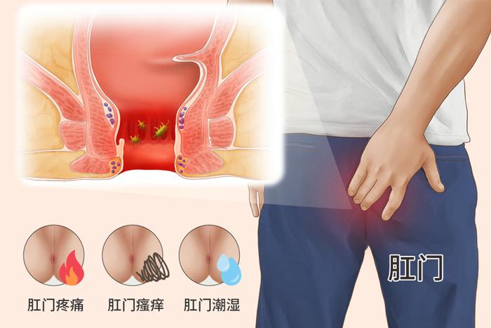 肛门癌能活多久图片