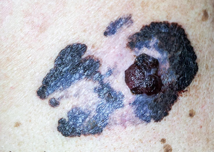 癌症不是突然来临的?医生提醒:皮肤若有这几个症状,请尽早检查