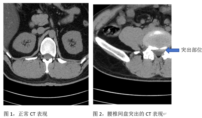 腰椎间盘突出了,内服中药也能"喝回去"?