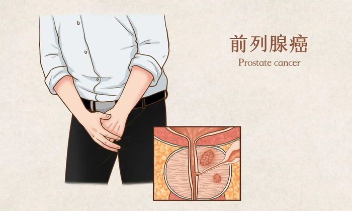 pet/ct检查医生建议郎大伯并在前列腺右侧叶触诊到硬结后在对郎大伯