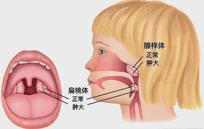 扁桃体隐窝在哪个位置图片