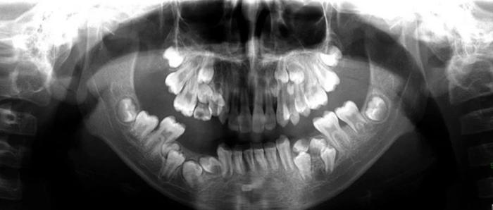 成人多生牙图片
