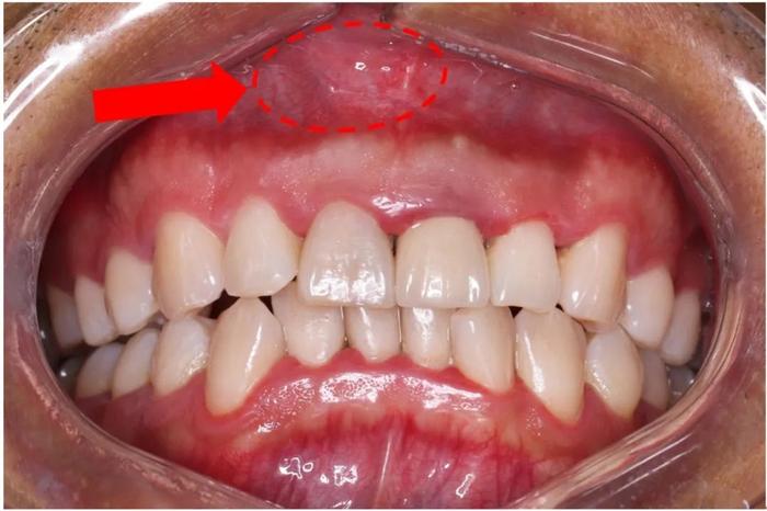 陈先生最近发现上门牙牙龈根处长了个肿块,右上门牙也有些变色,还伴有