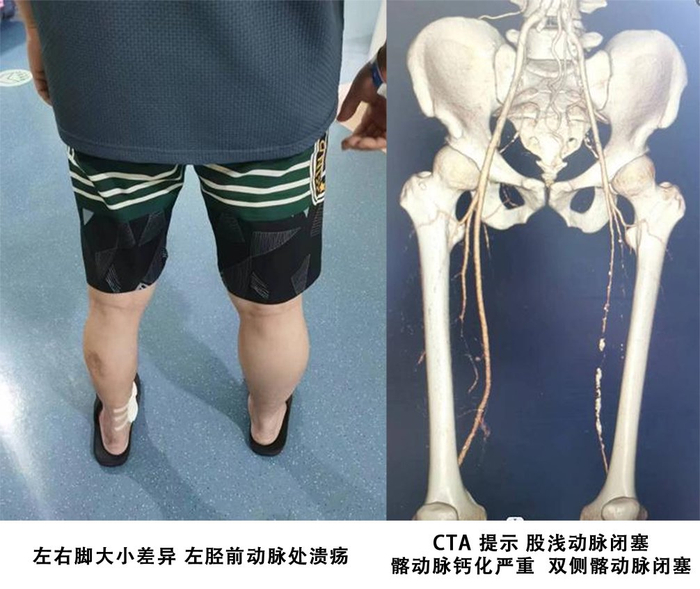 术中动脉造影显示,李先生多次动脉硬化严重,髂动脉及下肢动脉多处闭塞
