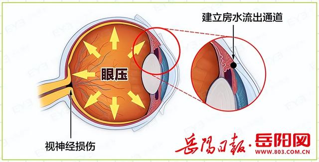 易被忽视,但一旦视力受损,往往已至病程晚期,视野缺损严重,且不可恢复