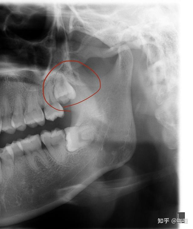 智齿大揭秘!这些危害你绝对不能忽视!