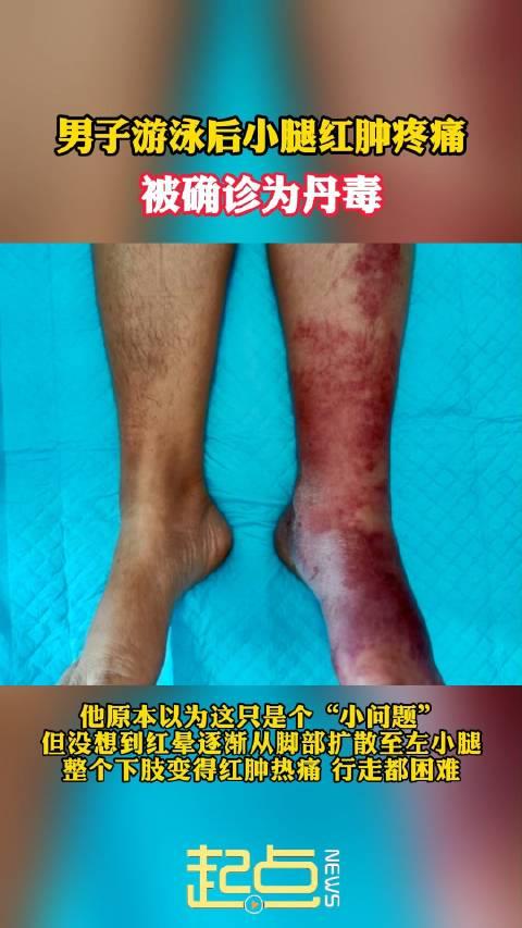 男子游泳后小腿肿痛染上丹毒