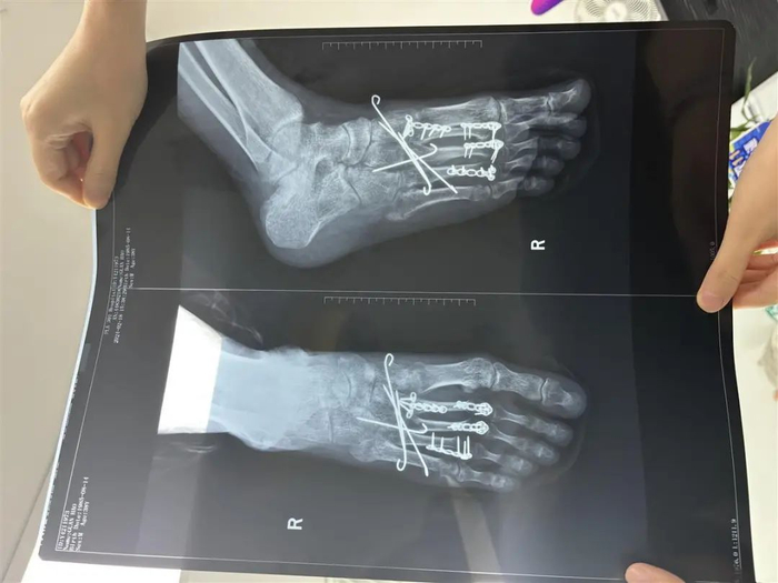 关先生脚部骨折