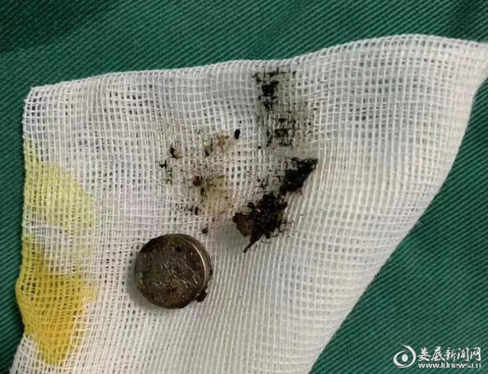 小异物 大隐患——警惕小儿鼻腔异物!