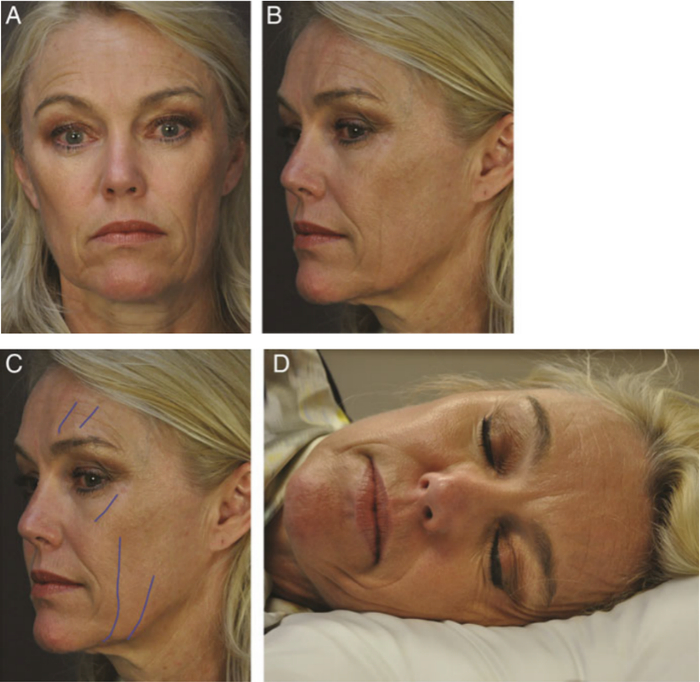 典型的睡眠皱纹（C 图中蓝色线条） 图源：参考资料