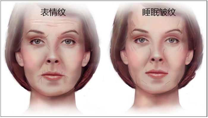 常见的表情纹和常见的睡眠皱纹对比 图源：参考资料