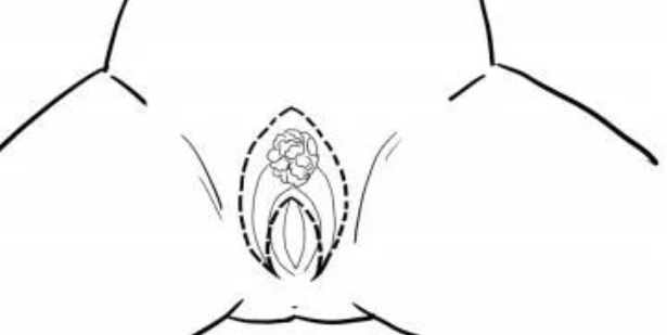 图2：外阴癌的“三切口”术式