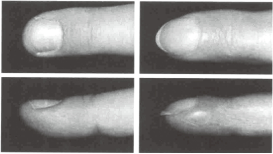 正常手指与杵状指外观对比图