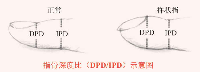 正常指甲 IPD 大于 DPD vs. 杵状指 DPD 大于 IPD