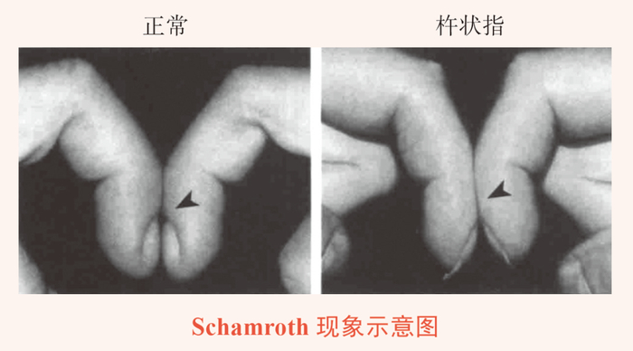 不存在杵状指的情况下，两食指相对，指甲间形成菱形间隙 vs 杵状指的甲床组织增加导致这个间隙闭合