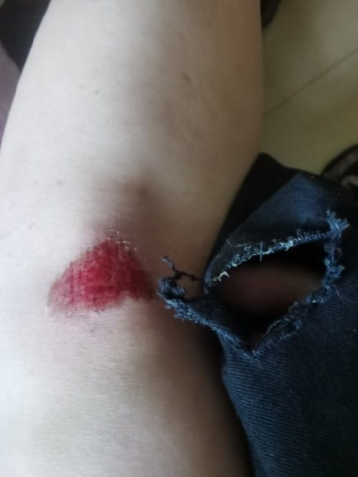 一大早出门,不小心踩空台阶摔了一跤,说是不小心…|台阶|膝盖|双腿