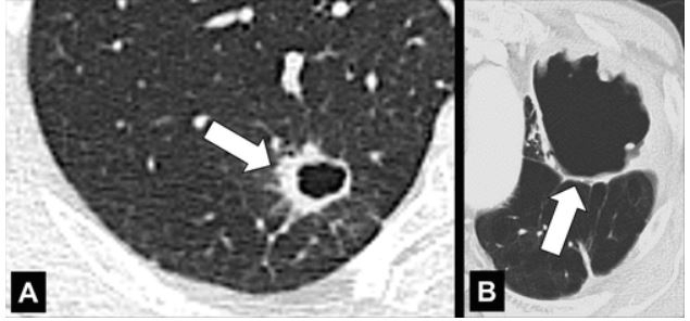 支气管|肺不张|胸膜_新浪新闻