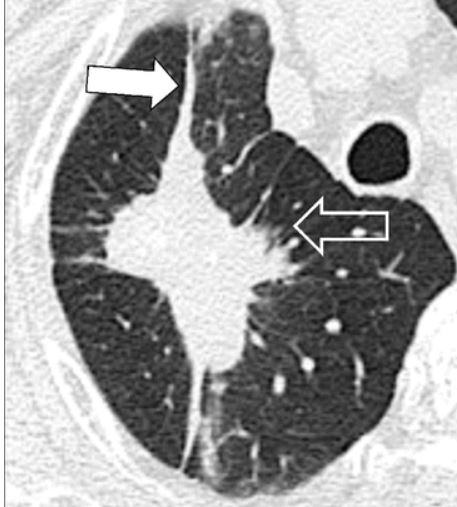 支气管|肺不张|胸膜_新浪新闻