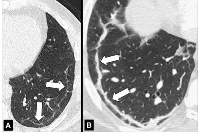 支气管|肺不张|胸膜_新浪新闻