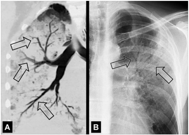 支气管|肺不张|胸膜_新浪新闻