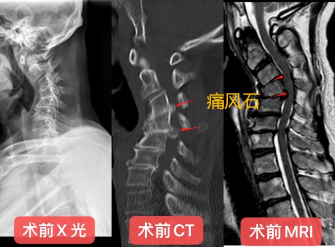 极其罕见 颈椎管内长满石头