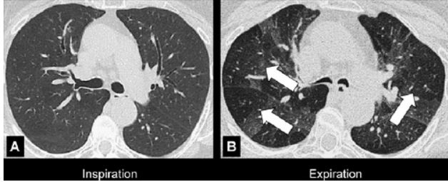 支气管|肺不张|胸膜_新浪新闻