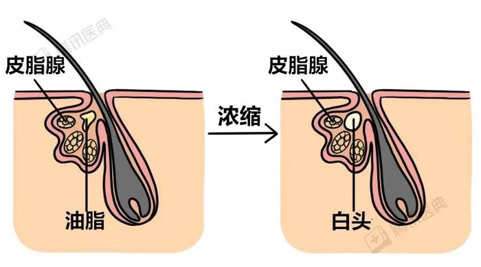 毛囊的样子 图片图片