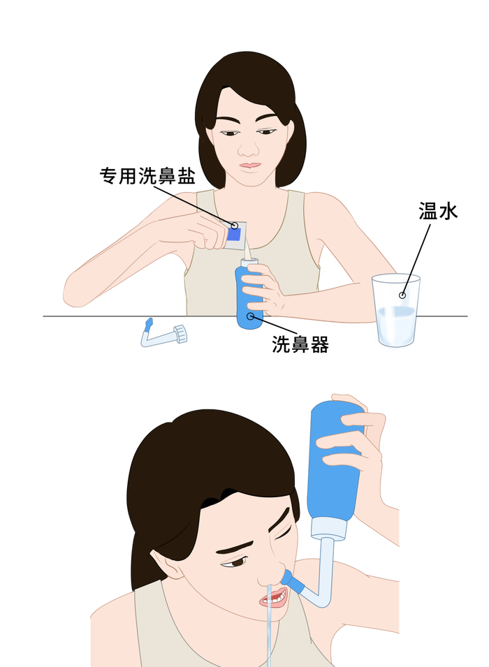 《中国变应性鼻炎诊断和治疗指南(2022年,修订版》,《中国慢性鼻窦炎