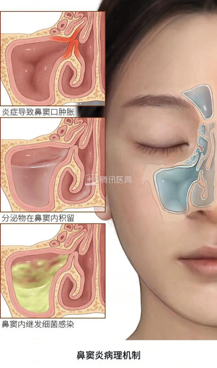 鼻窦炎真实图片