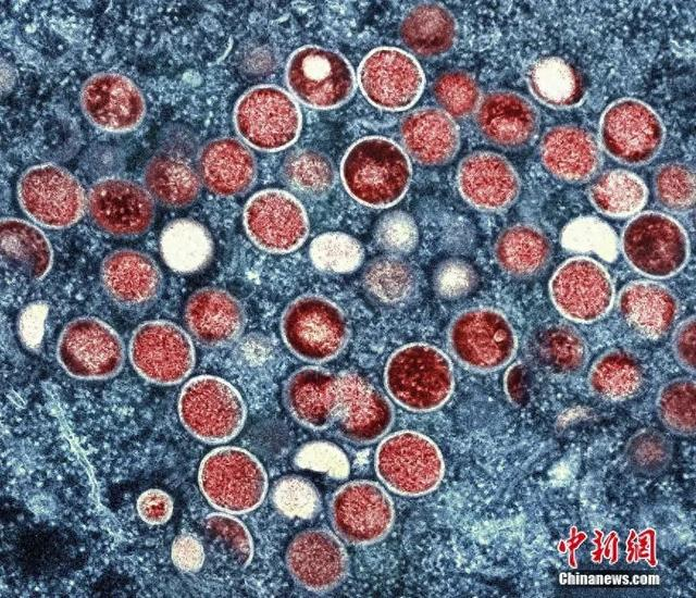 资料图：猴痘颗粒的彩色透射电子显微图。