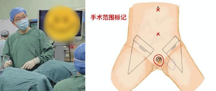 图3 手术范围示意图“外阴根治性局部扩大切除术 + 腹腔镜下双侧腹股沟淋巴结清扫术+带蒂皮瓣移植术”