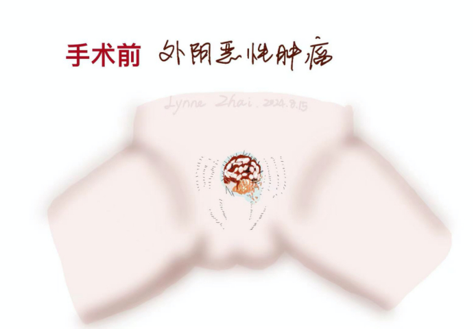 图1 患者外阴肿块手绘图