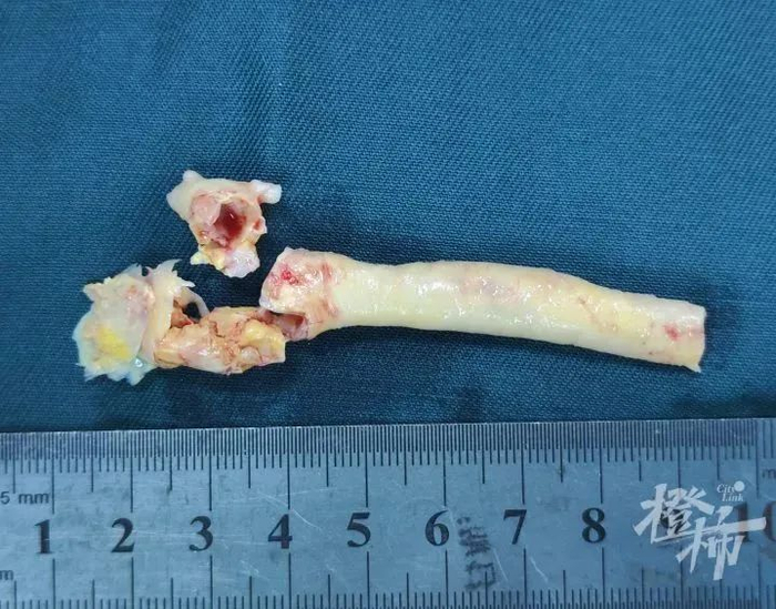 金先生切除的颈动脉斑块长度接近10厘米，直径约0.8厘米。图自都市快报·浙医在线微信公号
