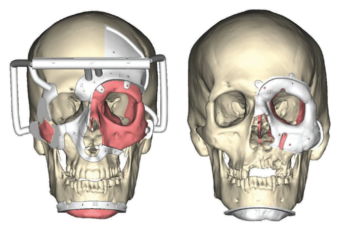 左图为供体取骨和组织；右图为受体移植后。图源/JAMA