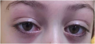 图3：双侧结膜炎