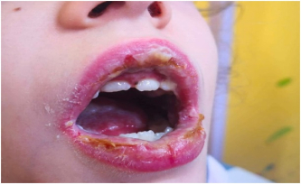 图2：黏膜炎和阿弗他口炎