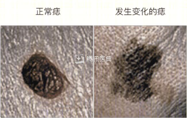 身上有痣要不要点?有这 5 个特点的要小心