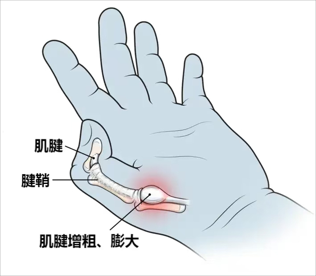 永医科普丨医生,我的大拇指疼痛|腱鞘|肌腱|大拇指_新浪新闻