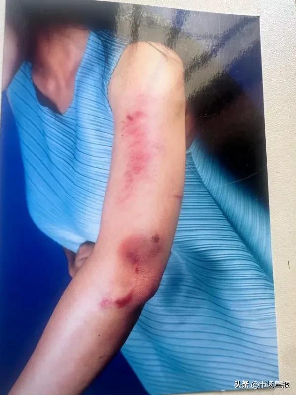 黄女士被殴打后的伤痕
