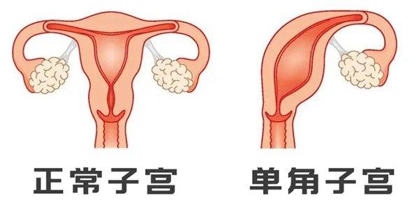 子宫角的位置示意图图片