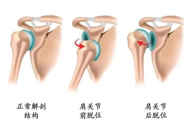 脱臼图片 示意图图片